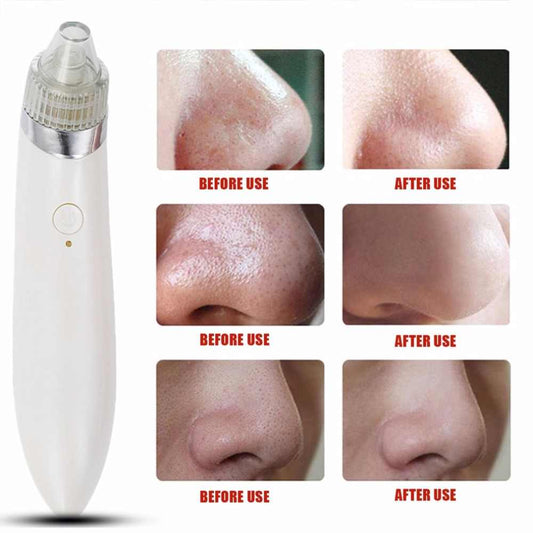 Electric Vaccum Acne Removal-Rechargable